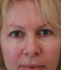 Feel Beautiful - Eyelids 114 - Before Photo